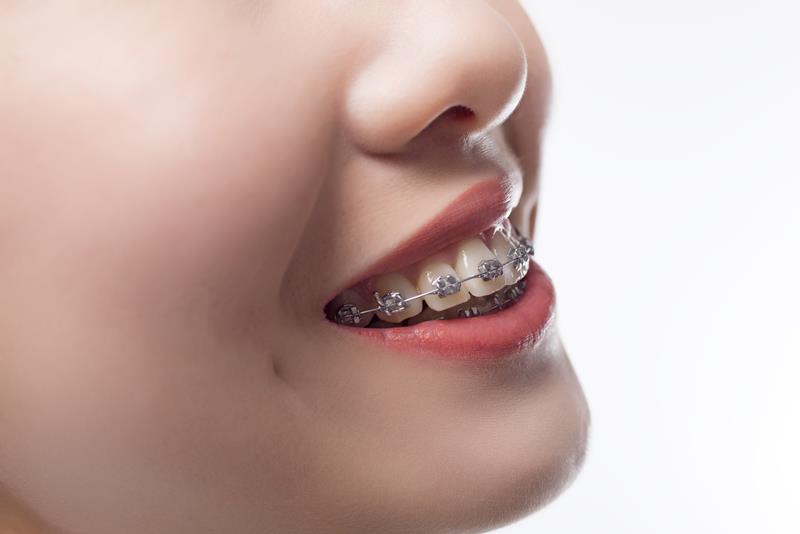 Do It Yourself Braces RxSmile Frisco Orthodontist Frisco Invisalign