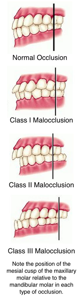 Dental Malocclusion Misaligned Teeth Rxsmile Frisco Orthodontist
