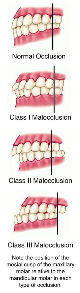 dental-malocclusion-misaligned-teeth-rxsmile-frisco-orthodontist