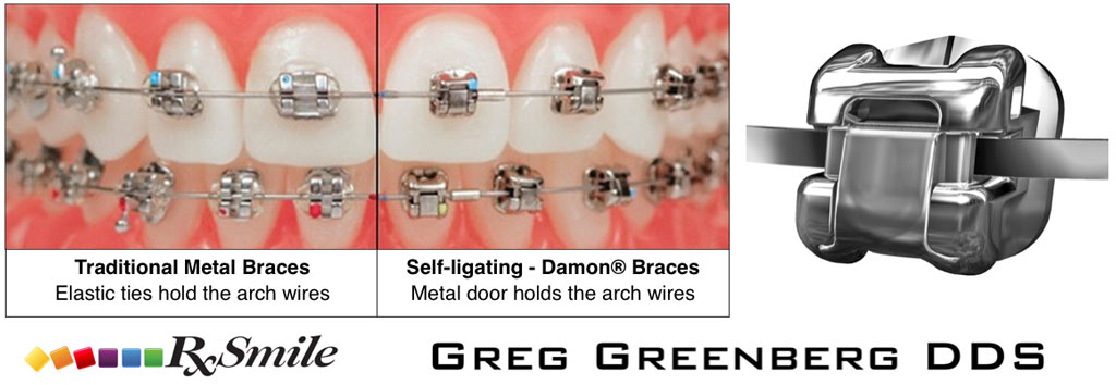 Damon Braces In Frisco Tx Rxsmile Frisco Orthodontics