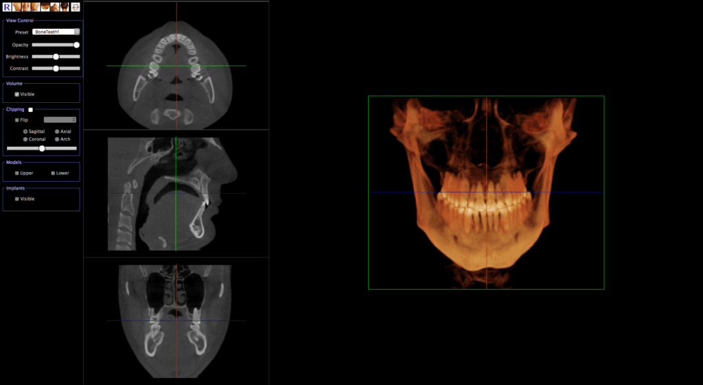 RxSmile iCAT 3D ortho results