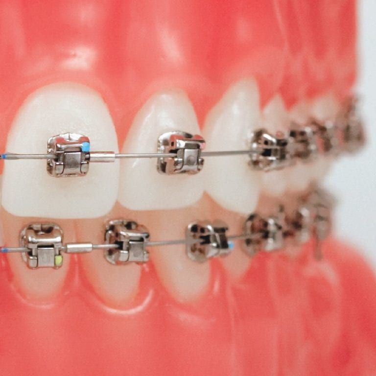 Passive Self-Ligating Braces in Frisco, TX | RxSmile Frisco ...