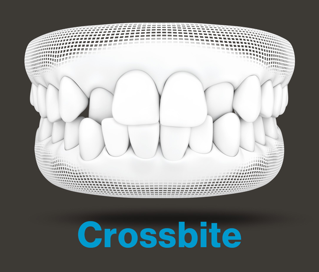 RxSmile Orthodontics Invisalign crossbite