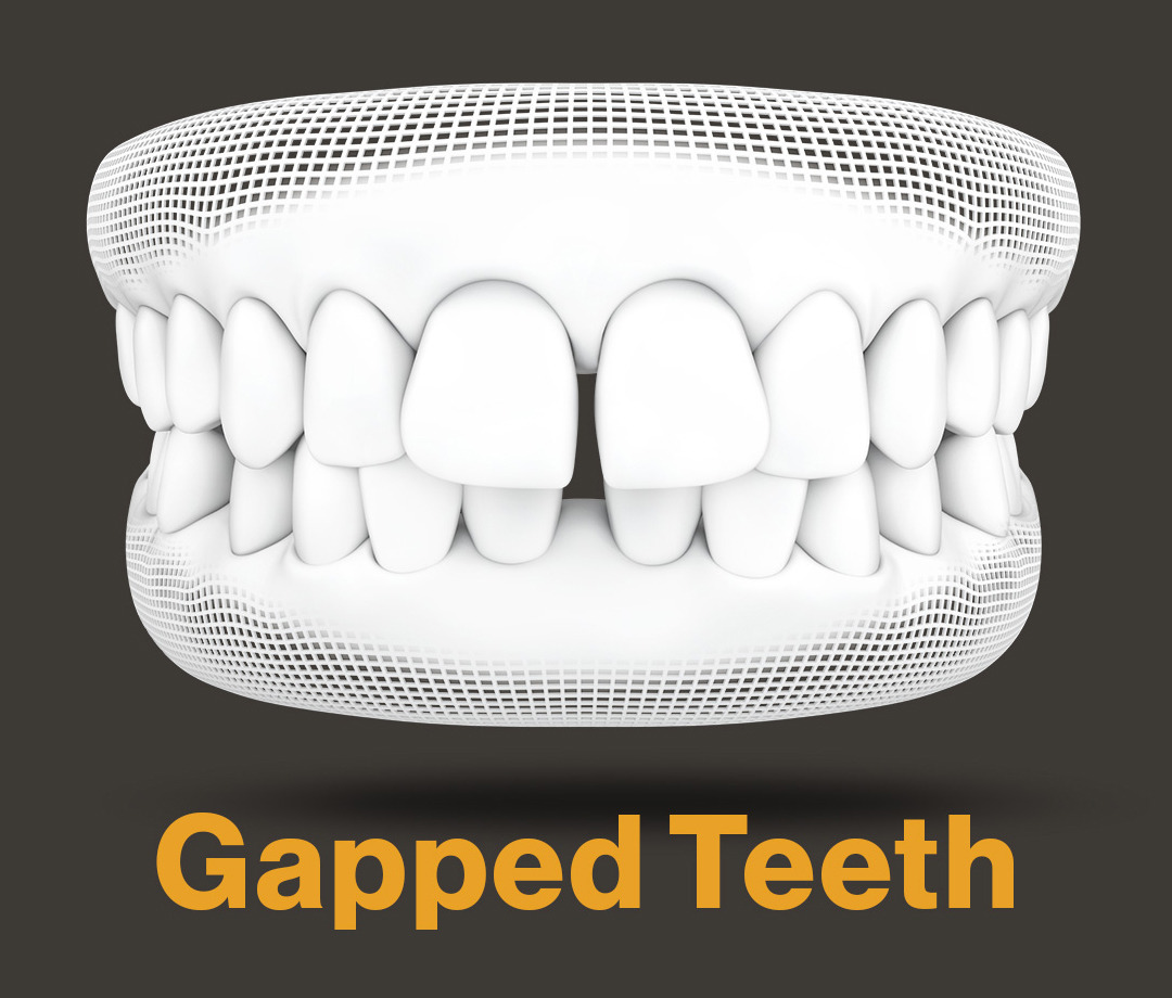 RxSmile Orthodontics Invisalign gapped teeth