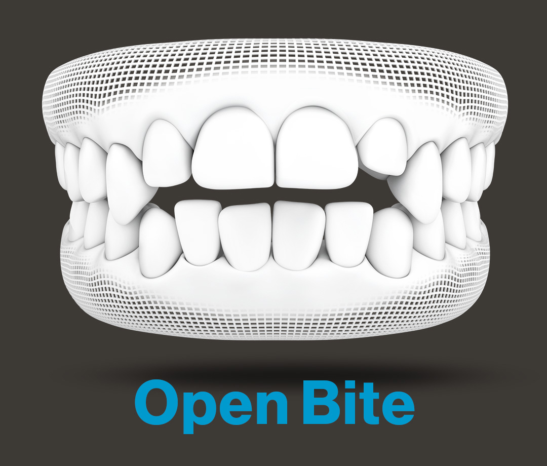 RxSmile Orthodontics Invisalign openbite