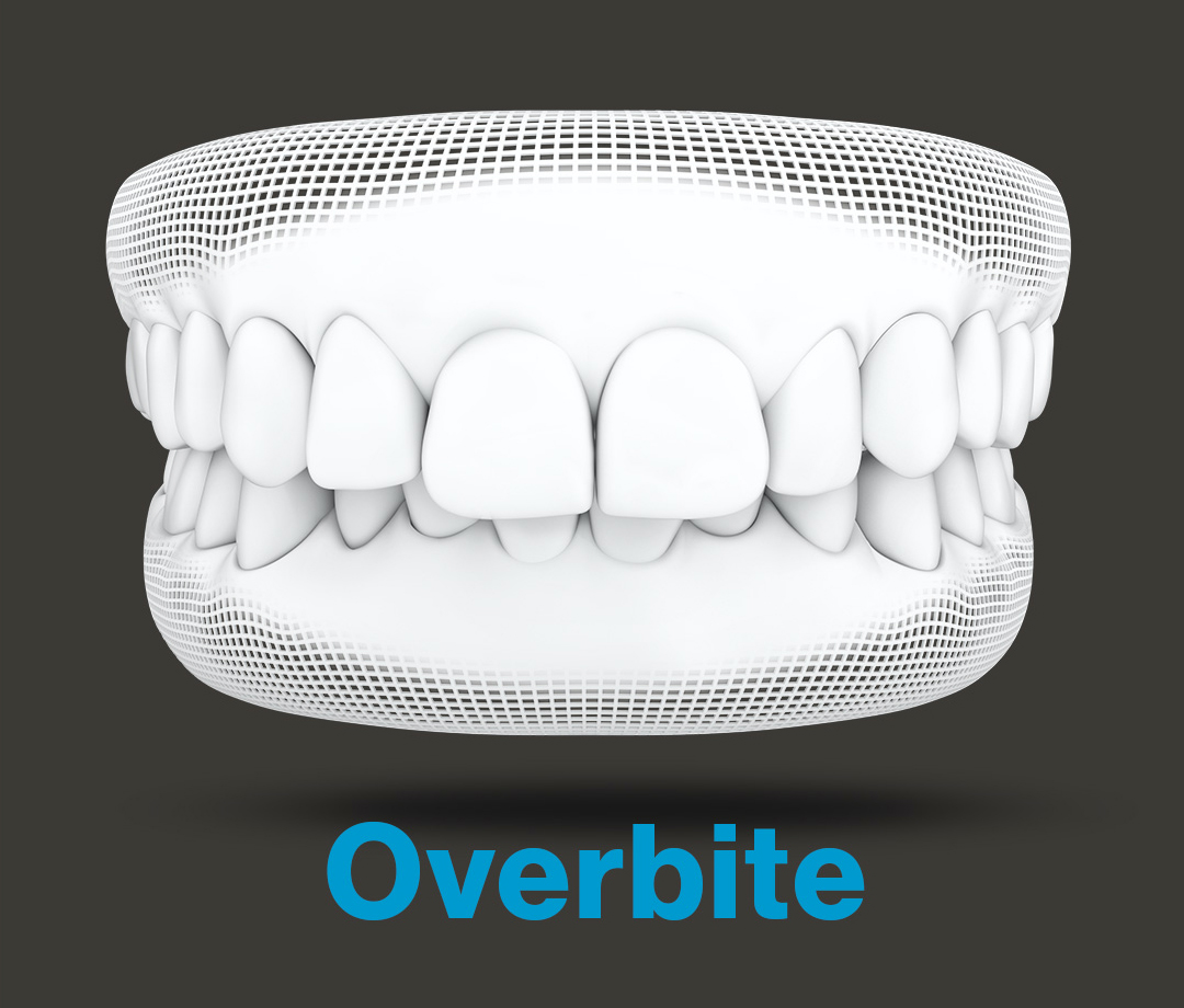 RxSmile Orthodontics Invisalign overbite