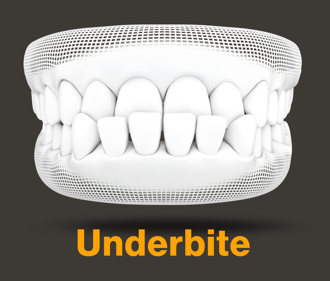 RxSmile Orthodontics Invisalign underbite