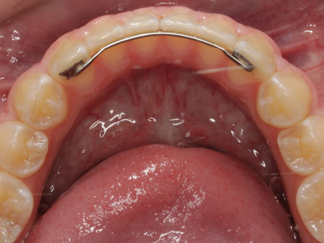 RxSmile orthodontist frisco retainer