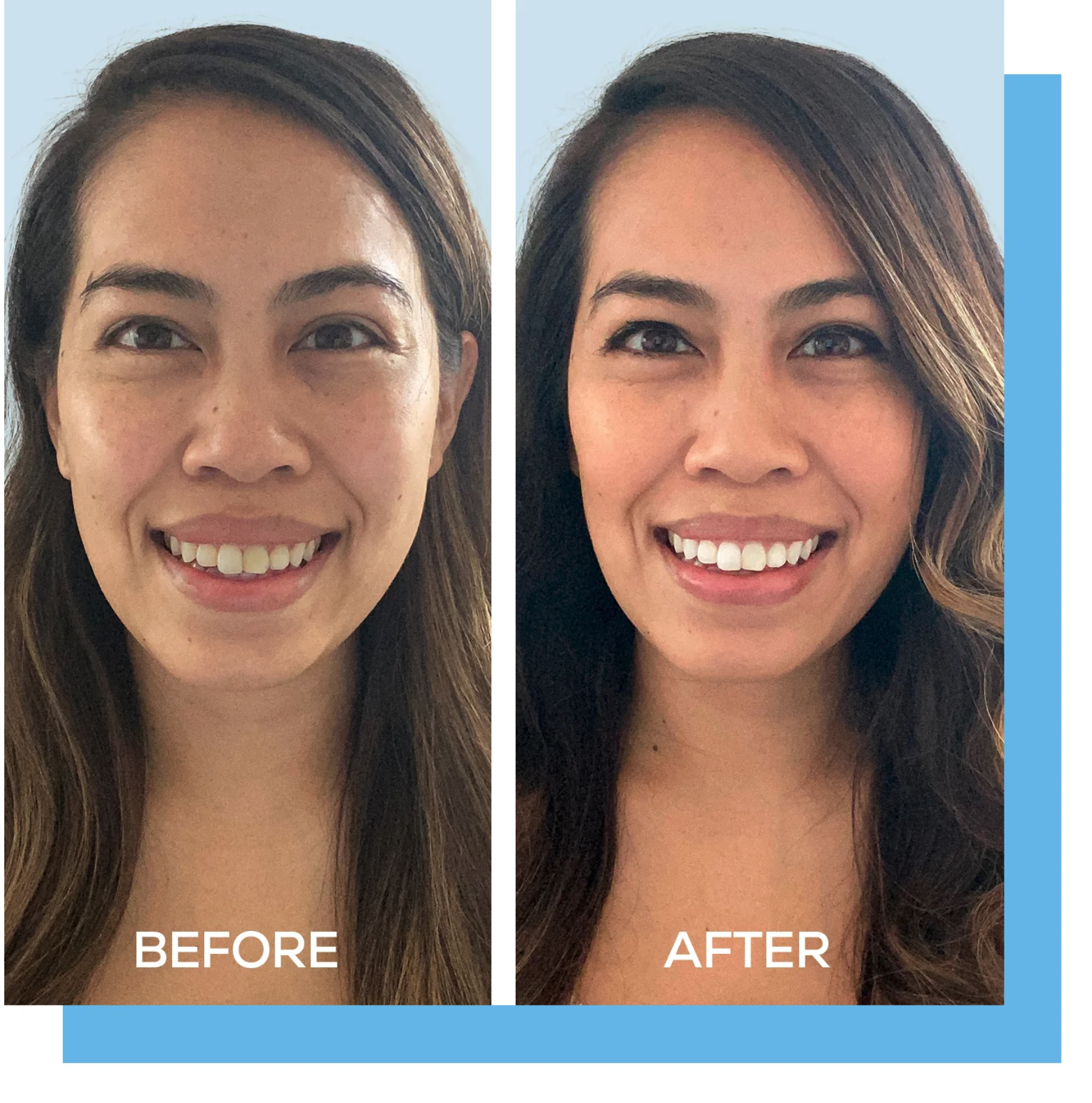 GLO Science Teeth Whitening patient Before & After results
