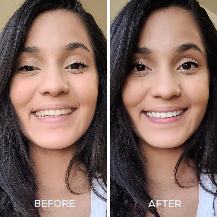 GLO teeth whitening before and after results