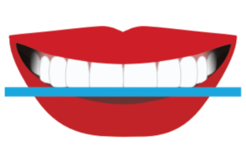 Flat-Smile-example