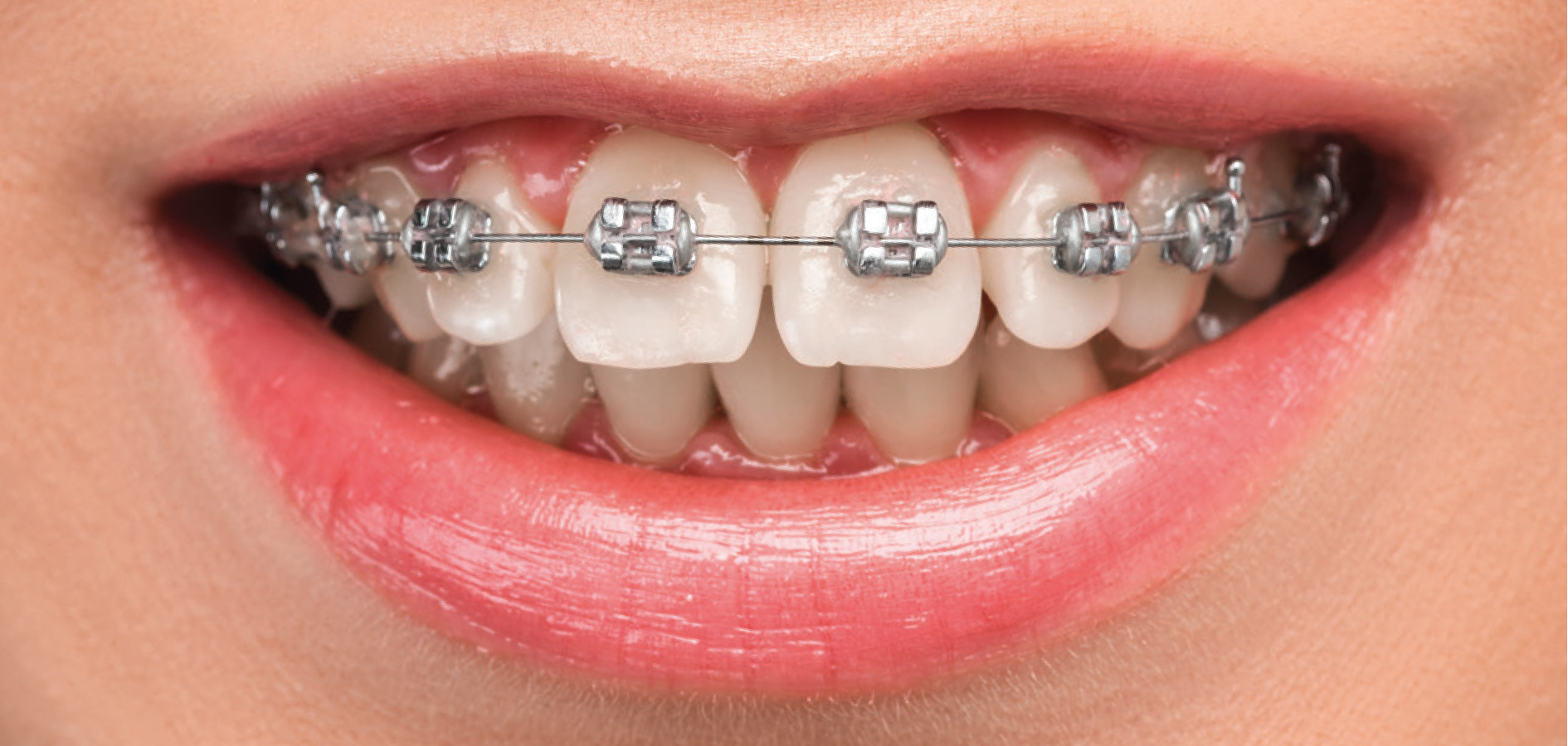 Traditional Brackets