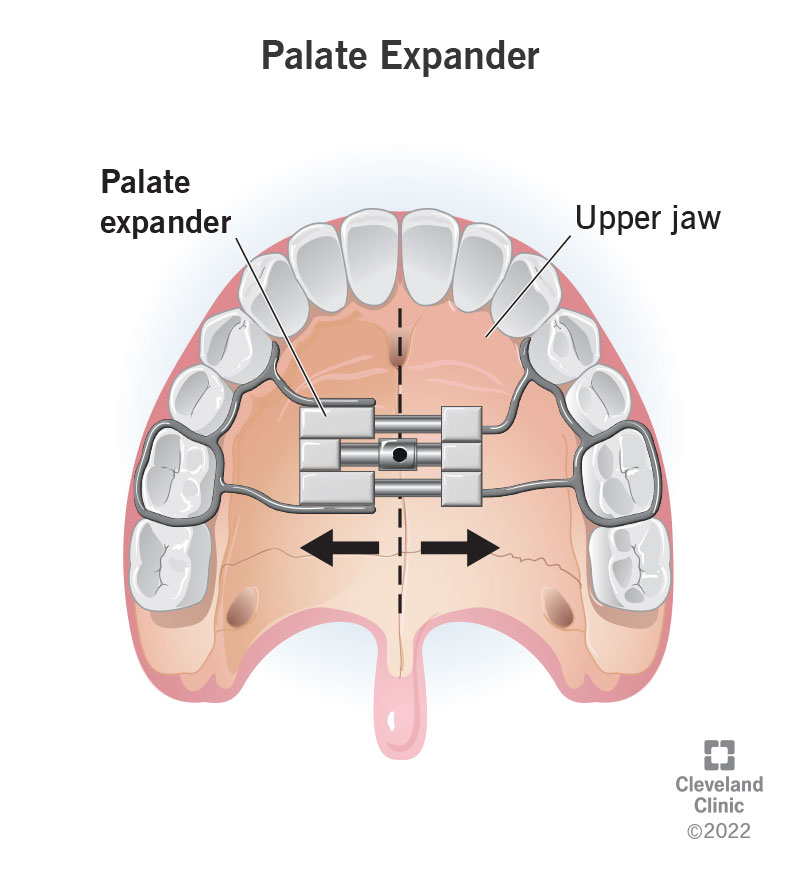 RPE-rapid-palate-expander