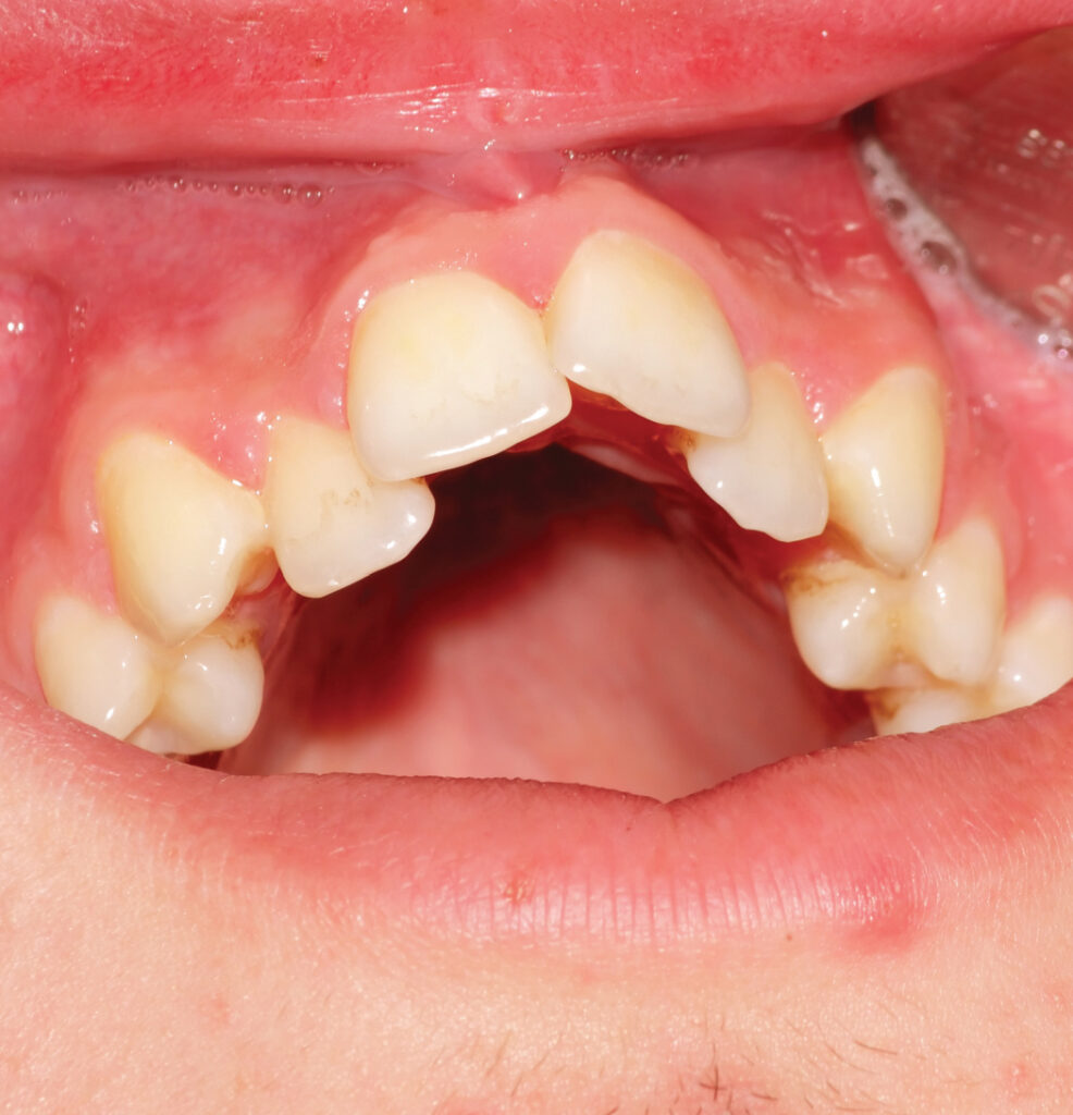 effects of thumb sucking effects of thumb sucking on the teeth